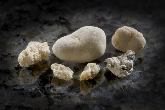Sechs Harnsteine in verschiedenen Größen