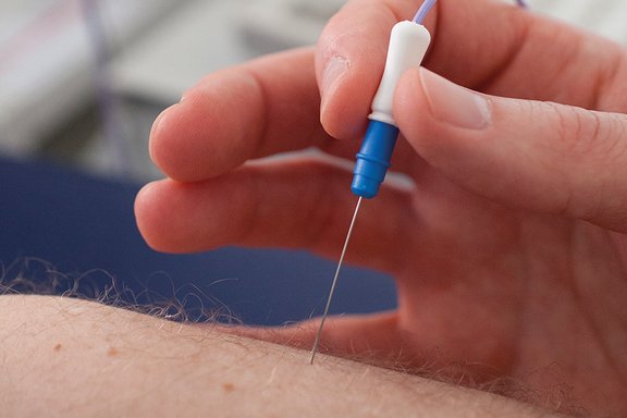 Eine elektromyographische Untersuchung am Arm.