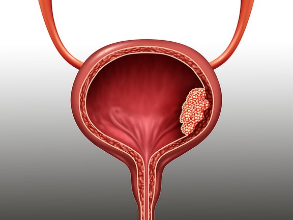 Schematische Darstellung der Harnblase mit Tumor