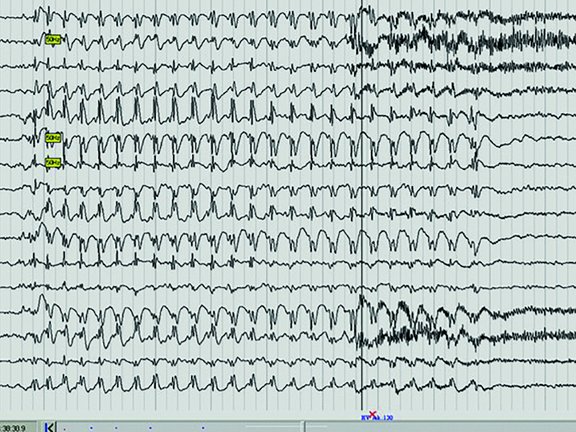 Abbildung eines EEG-Kurvendiagramms.