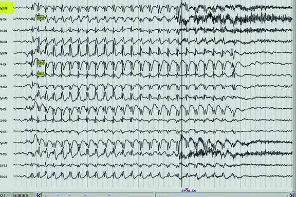 Abbildung eines EEG-Kurvendiagramms.